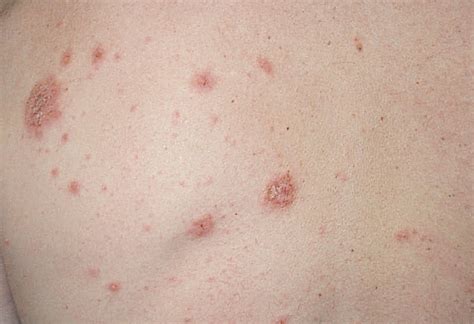 Severe Generalized Nummular Eczema Secondary To Interferon Alfa 2b