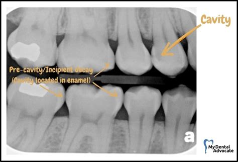 What Does A Cavity Look Like 20 Pictures