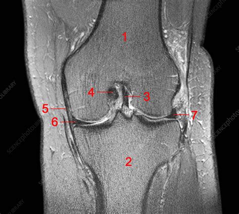 Normal Knee Mri Scan Stock Image C0261156 Science Photo Library