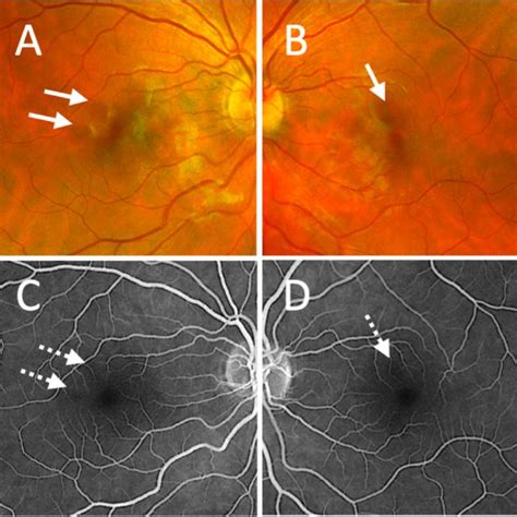 Fundus Photography A B And Intravenous Fluorescein Angiography C