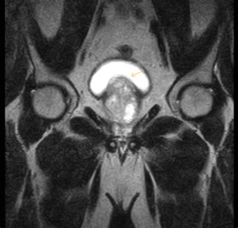 Benign Prostatic Hypertrophy Mri Sumer S Radiology Blog