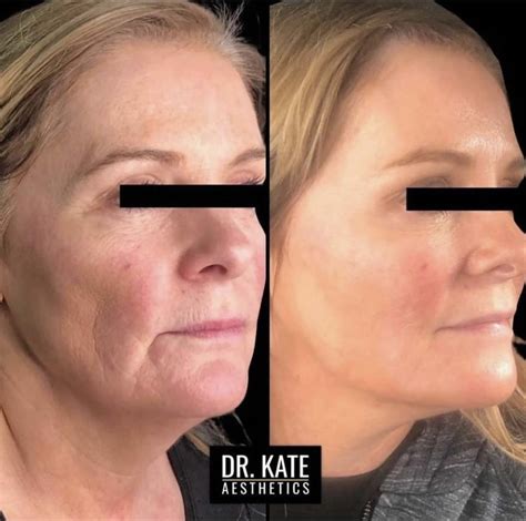 5 benefits of using chemical peels from dr kate aesthetics aesthetics and skin care clinic in