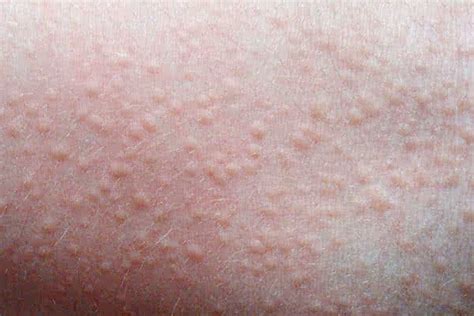 Rashes During Pregnancy Treatment Of Rashes In Pregnancy