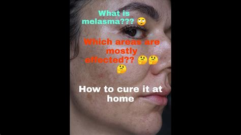 How To Treat Melasma At Home Melasma Cure Melasma Home Made