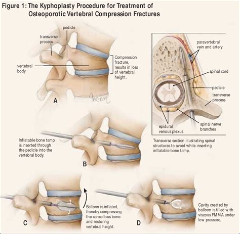 Figure From Kyphoplasty And Vertebroplasty For The Treatment Of Osteoporotic Vertebral