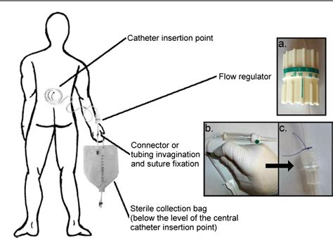 Flow Regulated External Lumbar Drain Applications And Complications