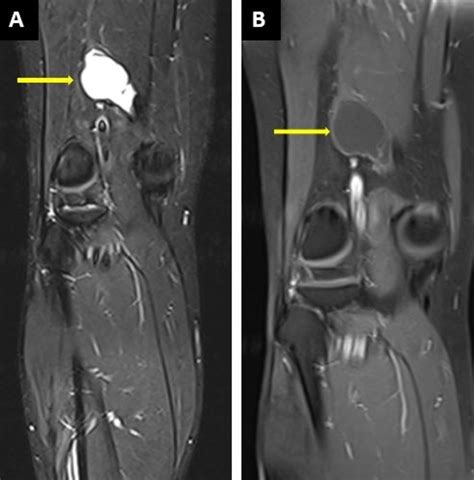 Cureus Intratendinous Ganglionic Cyst Of Semimembranosus A Rare Cause Of Thigh Swelling