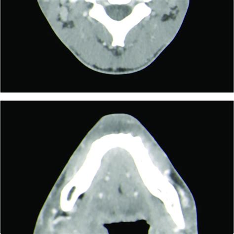 Cervical Ct Scan Showing Right Tonsillar Abscess Complicated By