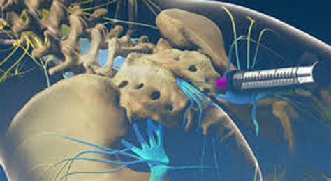 Nerve Blocks, Neural Therapy, and Nerve Hydrodissections - Motion Is