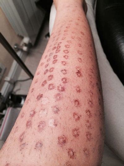 Laser hair removal can be dangerous in inexperienced hands. Burns from Laser Hair Removal - Lightsheer Laser review ...