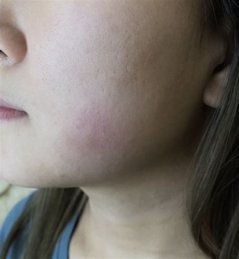 Acne Itchy Face Irritations That Look Like Mosquito Bites But Are