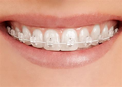 Restoring Your Smile With Clear Fixed Braces Blog