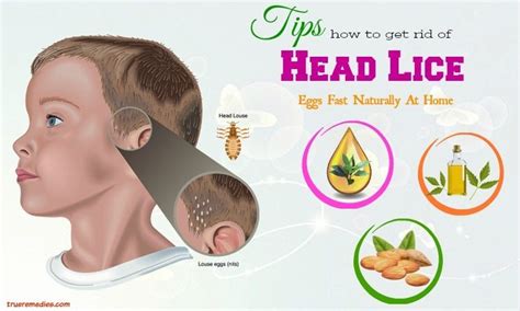 29 Tips How To Get Rid Of Head Lice Fast Eggs Fast At Home