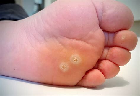 Plantar Warts Signs Symptoms Causes And Treatment