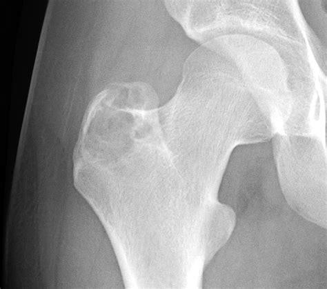 Benign Lucent Bone Lesions Radiology Case Collection