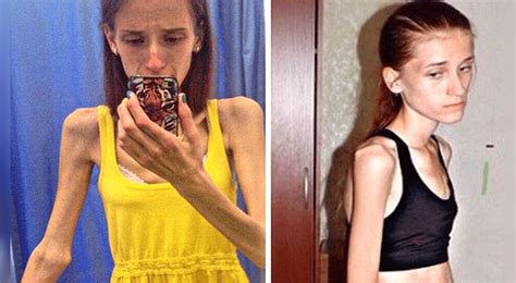Casi Muere Por La Anorexia Se Recuperó Y Ahora Luce Un Cuerpo De