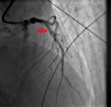 Post Angioplasty Cardiac Angiography The Arrow Shows Restored Blood