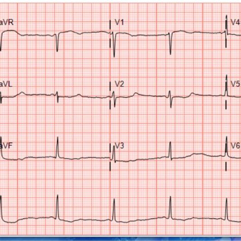 Post Cardiac Arrest EKG Demonstrating Inverted T Waves U Waves And