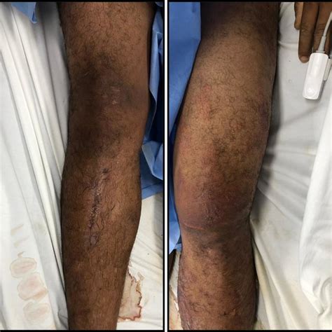 Lower Extremities Of A Patient Victim Of A Crush Injury The Left Thigh