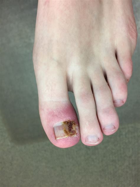 Ingrown Toenails Hagerstown Md And Frederick Md Reconstructive Foot
