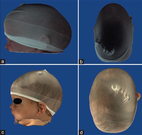 Endoscopy Assisted Craniosynostosis Surgery Followed By Helmet Therapy