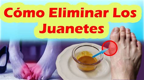 Como Eliminar Los Juanetes De Forma Natural COMO CORREGIR LOS JUANETES S Remedios Para