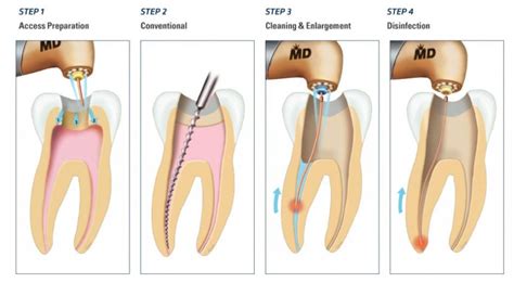 Root Canal Treatment In Mumbai Is Painless Spaceline Dental Studio