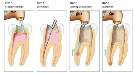 The infected area is really swollen; Root Canal Treatment in Mumbai is Painless | Spaceline ...