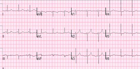 Dr Smiths Ecg Blog A 50 Something With Severe Chest Pain And A