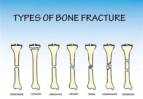 Types And Causes Of Bone Fractures Bone Fracture Types Of Bones