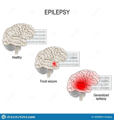 Epilepsy Brain Diagram