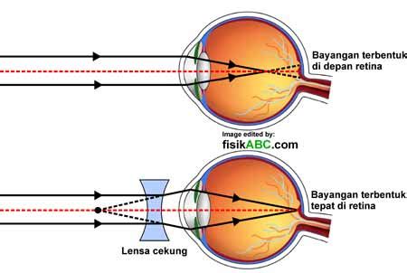 English (uk) · русский · українська · suomi · español. 4 Jenis Cacat Mata dan Lensa Kacamata Yang Dibutuhkan ...