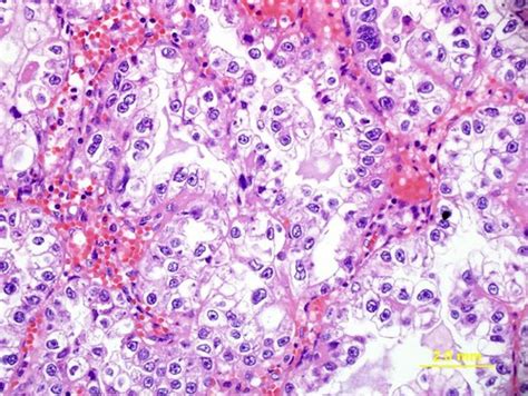 Qiaos Pathology Clear Cell Carcinoma Of Uterus Microscop Flickr
