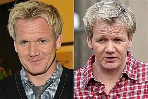 Gordon Ramsay And Other Celebs Who Ve Had Hair Transplants Irish