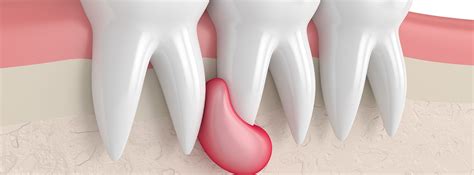 Common Causes Of Lumps On The Gums Zenith Dental Skin And Hair Clinic