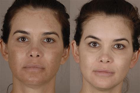 Potenza™ Rf Microneedling Before And After Pictures Case 34 Chico Yuba City And Oroville Ca