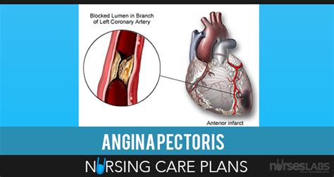 Proteinuria is associated with cardiovascular and renal disease and is a predictor of end organ damage in patients with hypertension. 4 Angina Pectoris (Coronary Artery Disease) Nursing Care Plans | Nursing care plan, Nursing care ...
