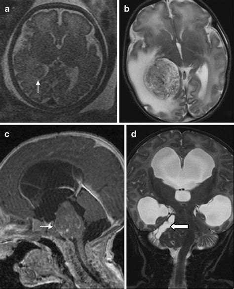 Intracranial Tumors Case 1 Choroid Plexus Papilloma Axial