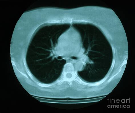 Granuloma And Calcification In Lung Photograph By Science Source