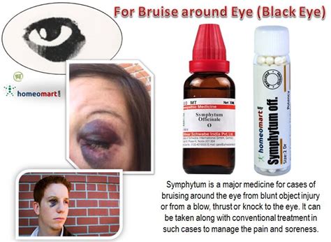 Black Eye Treatment At Home In Homeopath With Symphytum Off