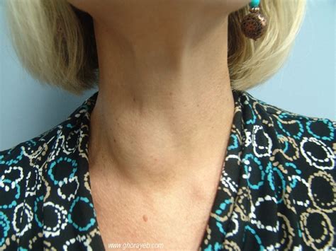 Thyroid Nodule Enlarged Thyroid