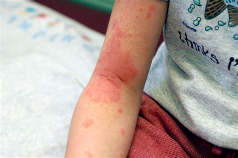 What Does Poison Ivy Look Like Identify Poison Ivy Rash And Plants