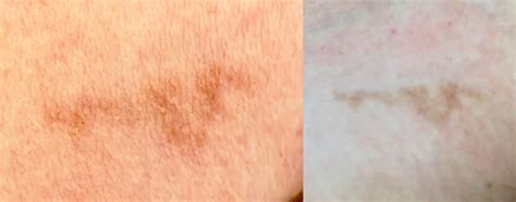 Skin Cancer On Arm