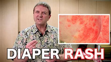 Diaper Rashes In Babies And Infants Pediatric Advice Youtube