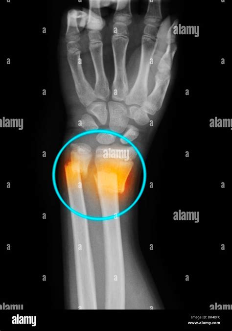 Distal Radius And Ulna Fracture With Displacement Stock Photo 31444320