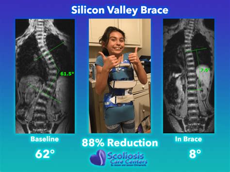 Can Chiropractic Help Fix Or Cure Scoliosis Scoliosis Care Centers