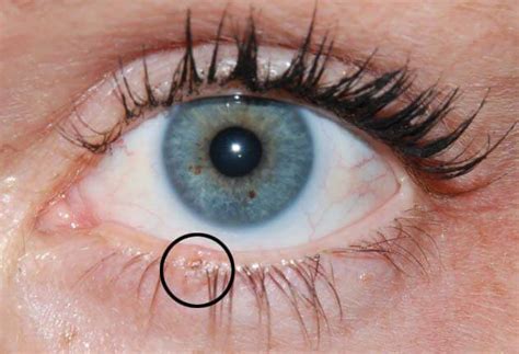 Basal Cell Carcinoma On Lower Eyelid