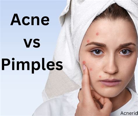 Acne Vs Pimples