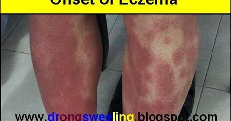 Tcm News Tcm Physician Treat Symptoms Of Severe Eczema With Natural Herbs