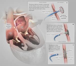 Patent Foramen Ovale After Cryptogenic Stroke Assessing The Evidence